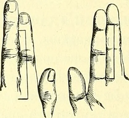 An illustration from Modern surgery, general and operative / by John Chalmers Da Costa., 1907, leaf 678