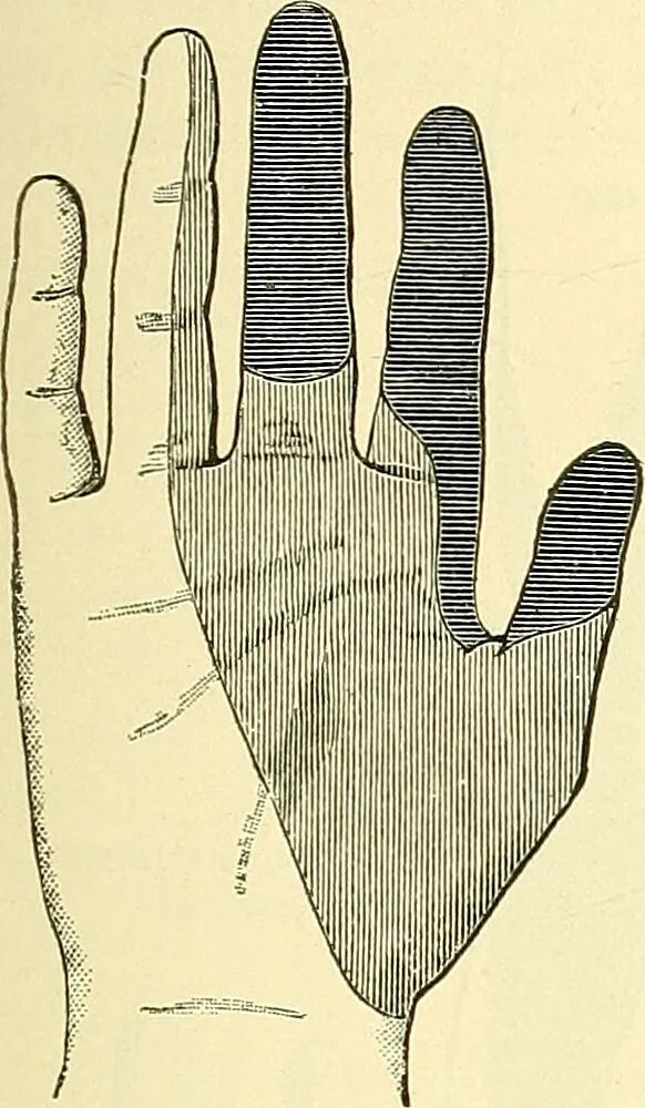 An illustration from Modern surgery, general and operative / by John Chalmers Da Costa., 1907, leaf 689