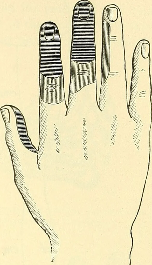 An illustration from Modern surgery, general and operative / by John Chalmers Da Costa., 1907, leaf 689