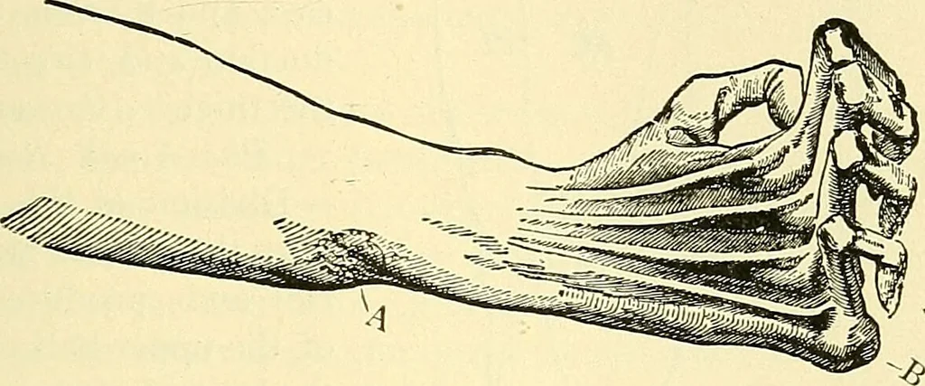 An illustration from Modern surgery, general and operative / by John Chalmers Da Costa., 1907, leaf 691