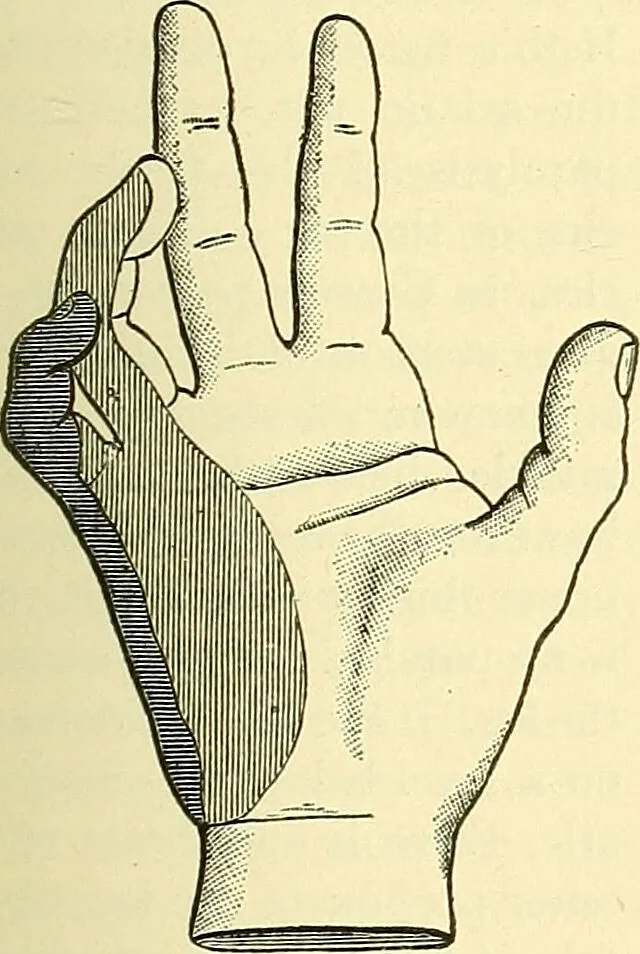 An illustration from Modern surgery, general and operative / by John Chalmers Da Costa., 1907, leaf 691