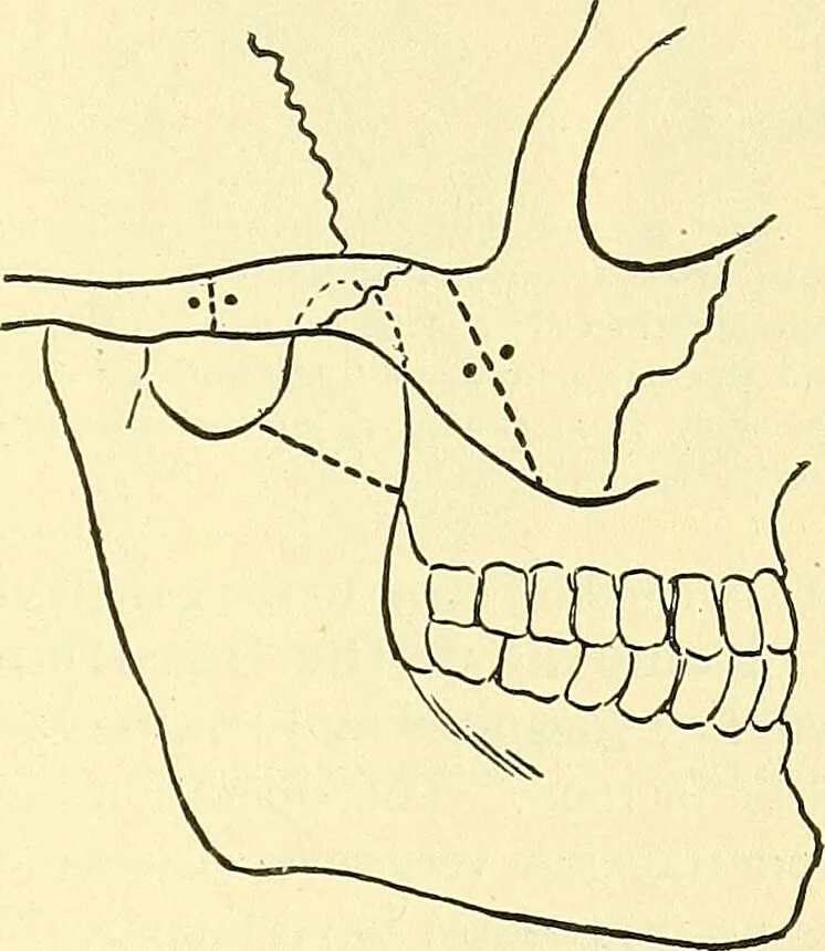 An illustration from Modern surgery, general and operative / by John Chalmers Da Costa., 1907, leaf 699