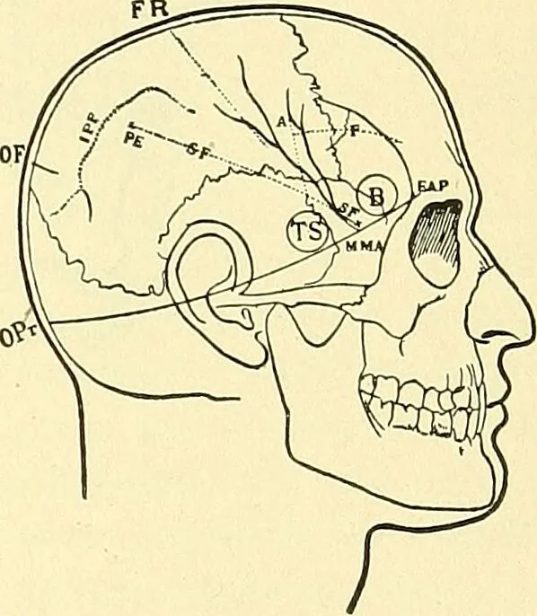 An illustration from Modern surgery, general and operative / by John Chalmers Da Costa., 1907, leaf 707