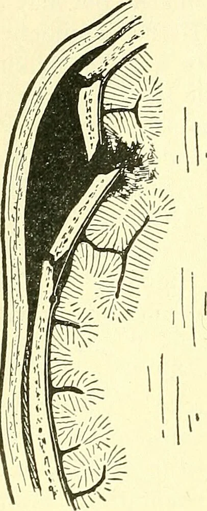 An illustration from Modern surgery, general and operative / by John Chalmers Da Costa., 1907, leaf 720