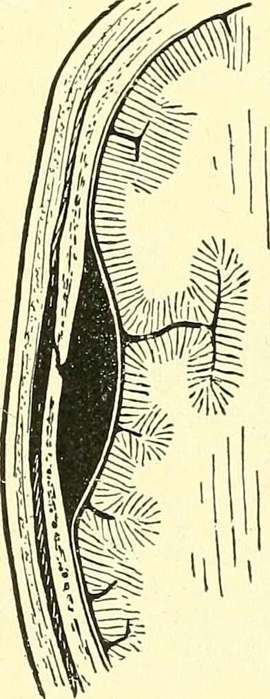 An illustration from Modern surgery, general and operative / by John Chalmers Da Costa., 1907, leaf 722