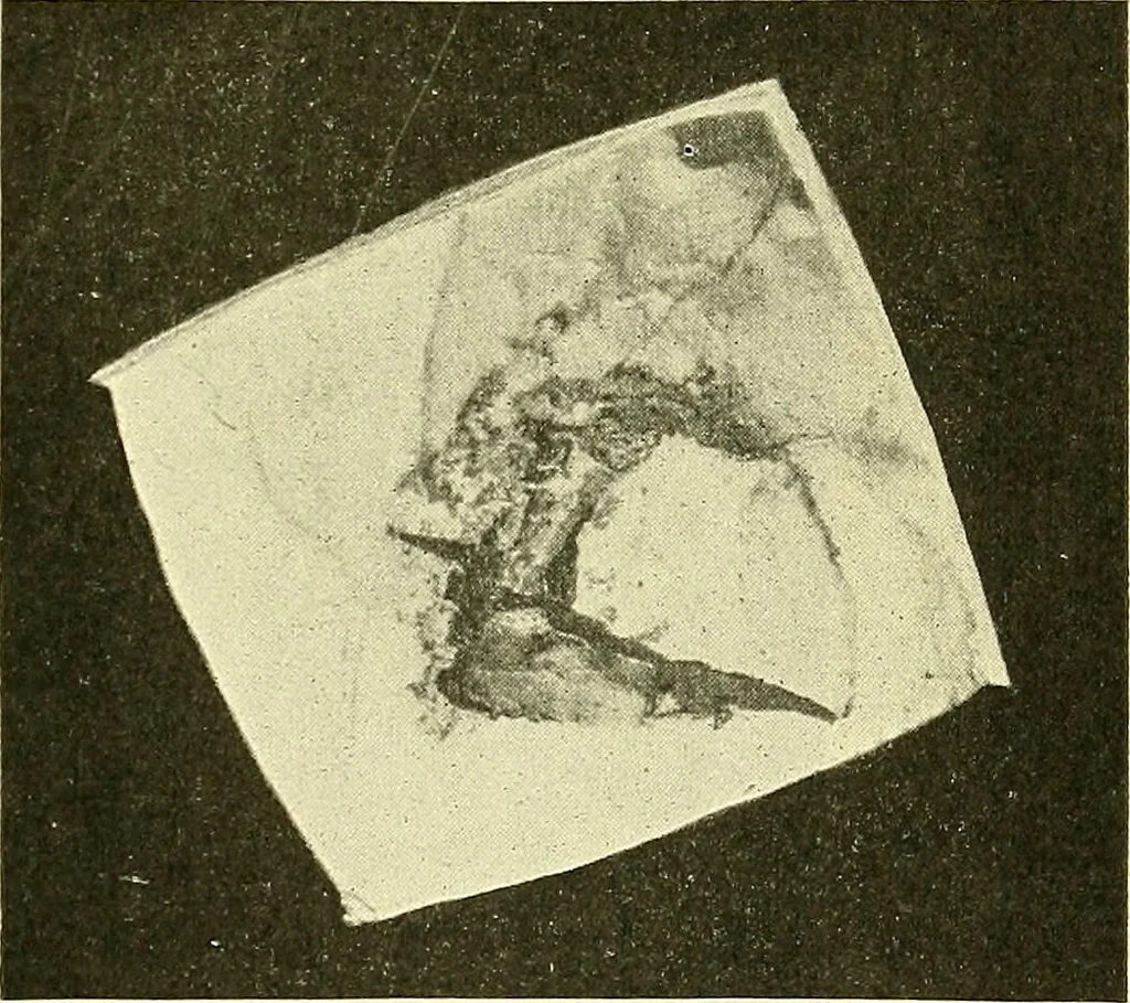 An illustration from Modern surgery, general and operative / by John Chalmers Da Costa., 1907, leaf 725