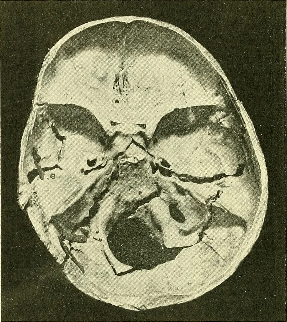 An illustration from Modern surgery, general and operative / by John Chalmers Da Costa., 1907, leaf 726