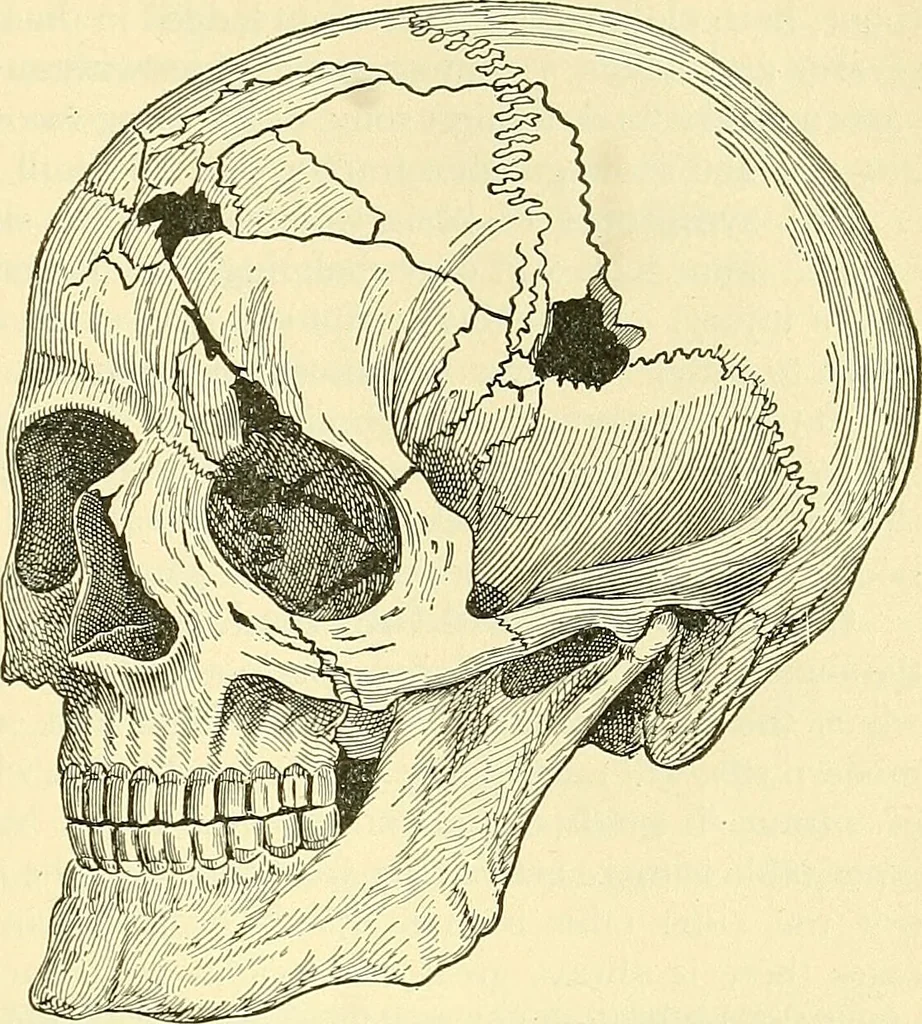 An illustration from Modern surgery, general and operative / by John Chalmers Da Costa., 1907, leaf 729