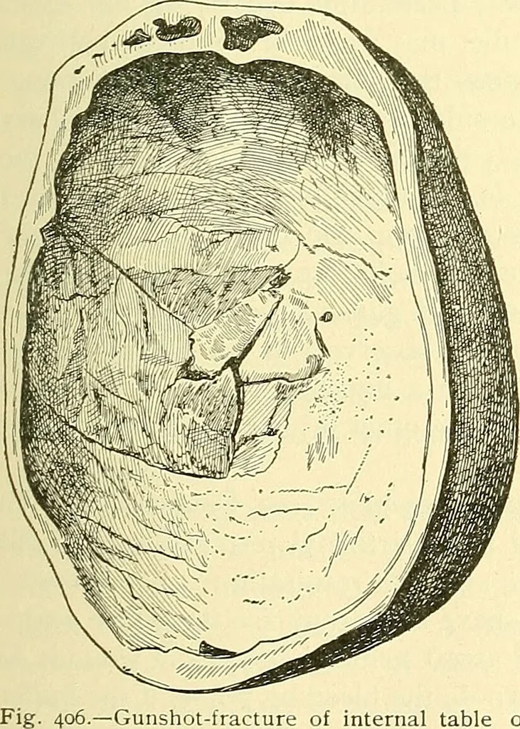 An illustration from Modern surgery, general and operative / by John Chalmers Da Costa., 1907, leaf 729