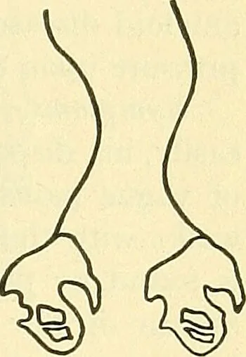 An illustration from Modern surgery, general and operative / by John Chalmers Da Costa., 1907, leaf 765