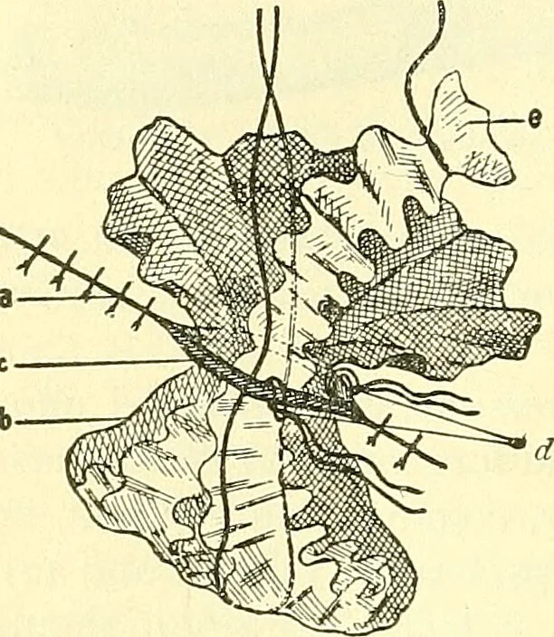An illustration from Modern surgery, general and operative / by John Chalmers Da Costa., 1907, leaf 78