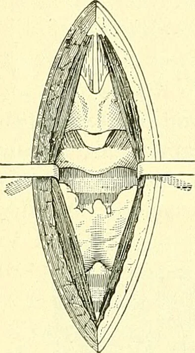 An illustration from Modern surgery, general and operative / by John Chalmers Da Costa., 1907, leaf 788