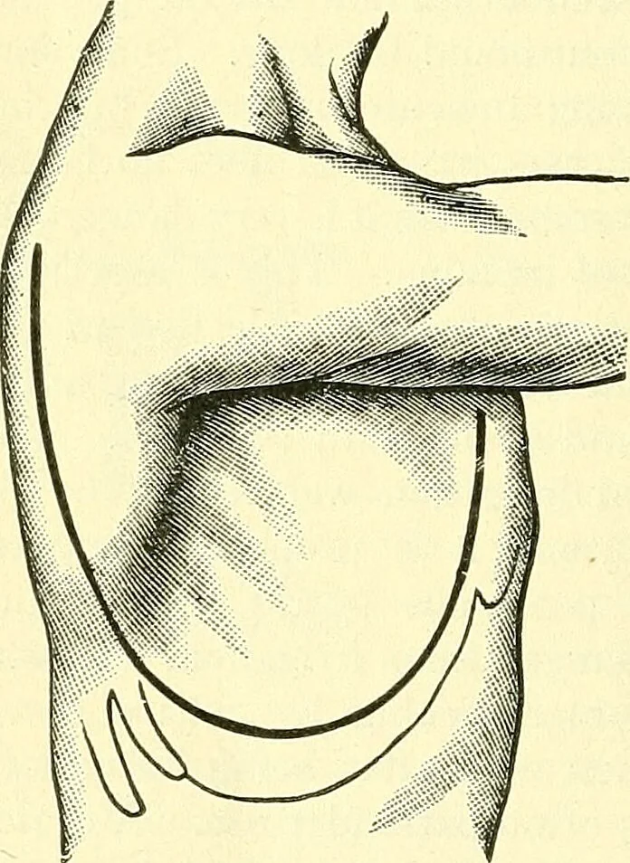 An illustration from Modern surgery, general and operative / by John Chalmers Da Costa., 1907, leaf 804