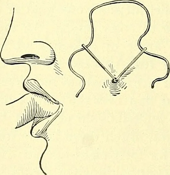 An illustration from Modern surgery, general and operative / by John Chalmers Da Costa., 1907, leaf 806