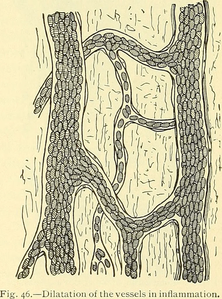 An illustration from Modern surgery, general and operative / by John Chalmers Da Costa., 1907, leaf 81