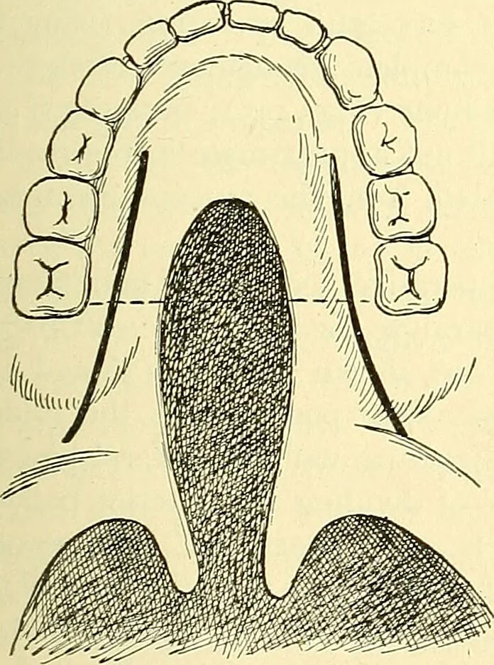 An illustration from Modern surgery, general and operative / by John Chalmers Da Costa., 1907, leaf 811