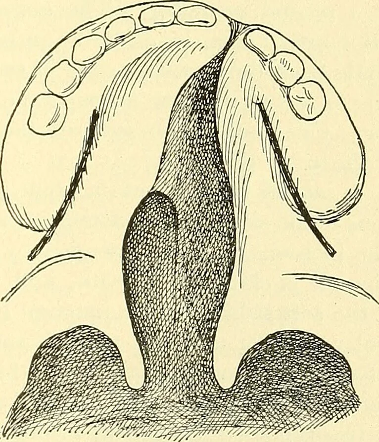 An illustration from Modern surgery, general and operative / by John Chalmers Da Costa., 1907, leaf 811