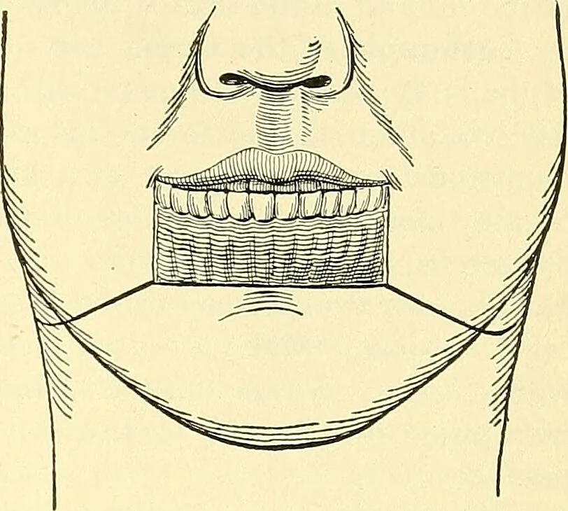 An illustration from Modern surgery, general and operative / by John Chalmers Da Costa., 1907, leaf 815
