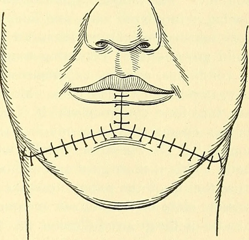 An illustration from Modern surgery, general and operative / by John Chalmers Da Costa., 1907, leaf 815