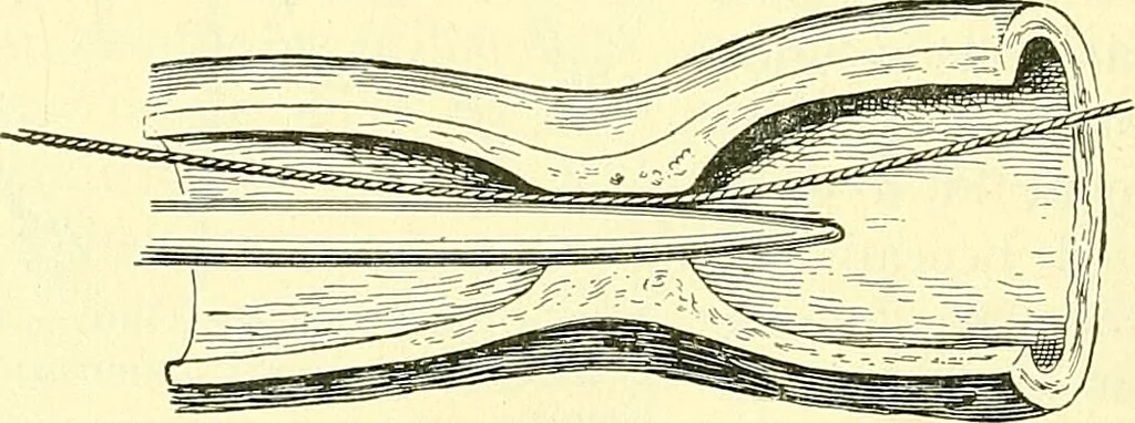 An illustration from Modern surgery, general and operative / by John Chalmers Da Costa., 1907, leaf 822