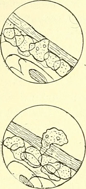 An illustration from Modern surgery, general and operative / by John Chalmers Da Costa., 1907, leaf 84
