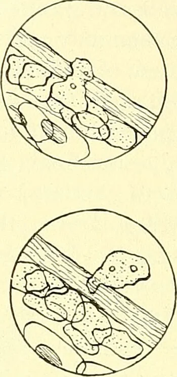 An illustration from Modern surgery, general and operative / by John Chalmers Da Costa., 1907, leaf 84
