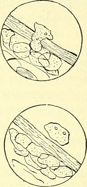 An illustration from Modern surgery, general and operative / by John Chalmers Da Costa., 1907, leaf 84