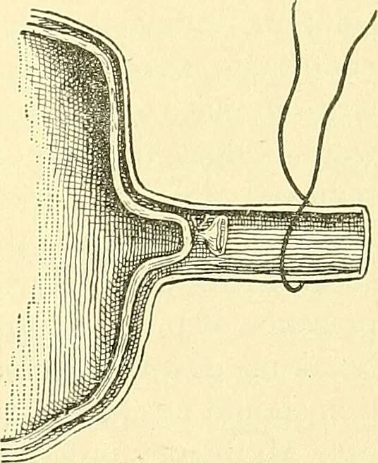 An illustration from Modern surgery, general and operative / by John Chalmers Da Costa., 1907, leaf 935