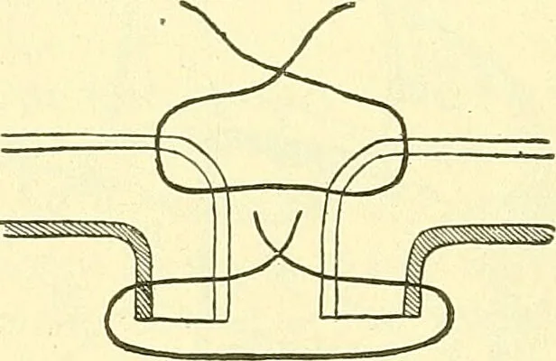 An illustration from Modern surgery, general and operative / by John Chalmers Da Costa., 1907, leaf 940