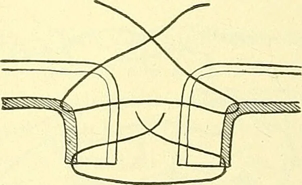 An illustration from Modern surgery, general and operative / by John Chalmers Da Costa., 1907, leaf 940