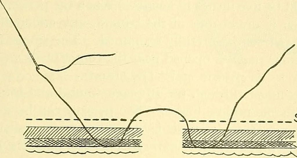 An illustration from Modern surgery, general and operative / by John Chalmers Da Costa., 1907, leaf 945