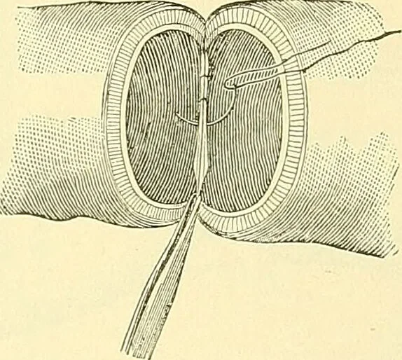 An illustration from Modern surgery, general and operative / by John Chalmers Da Costa., 1907, leaf 945