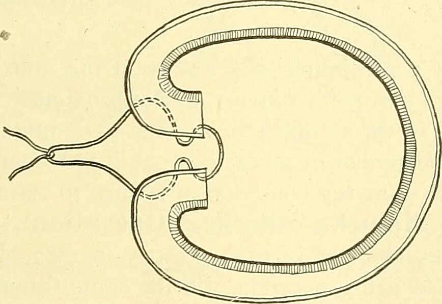An illustration from Modern surgery, general and operative / by John Chalmers Da Costa., 1907, leaf 945