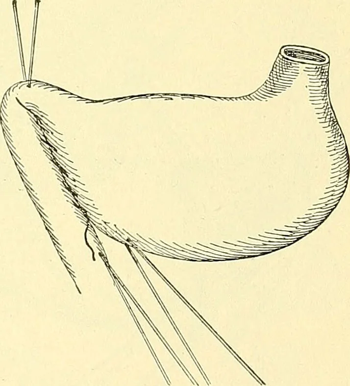 An illustration from Modern surgery, general and operative / by John Chalmers Da Costa., 1907, leaf 947