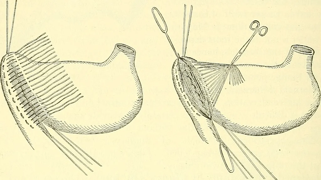 An illustration from Modern surgery, general and operative / by John Chalmers Da Costa., 1907, leaf 948