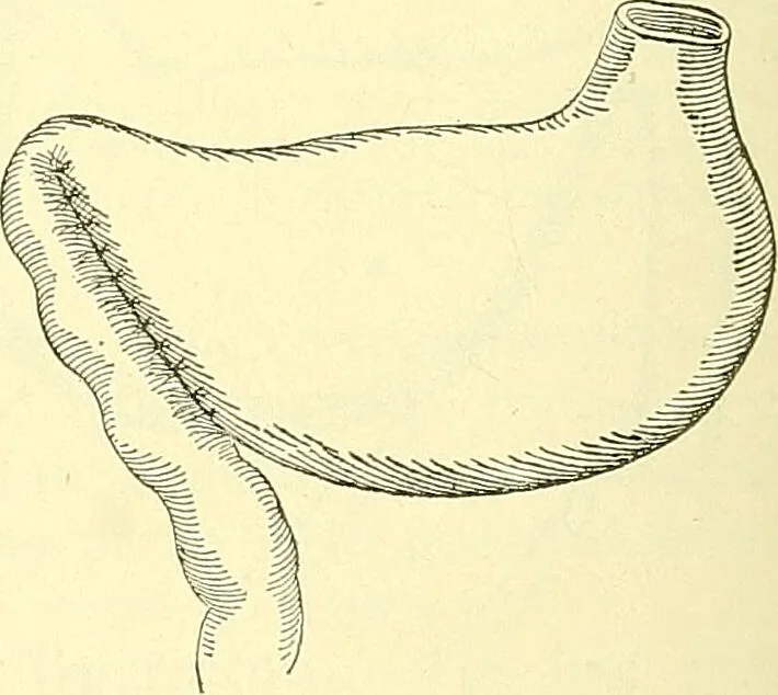 An illustration from Modern surgery, general and operative / by John Chalmers Da Costa., 1907, leaf 948