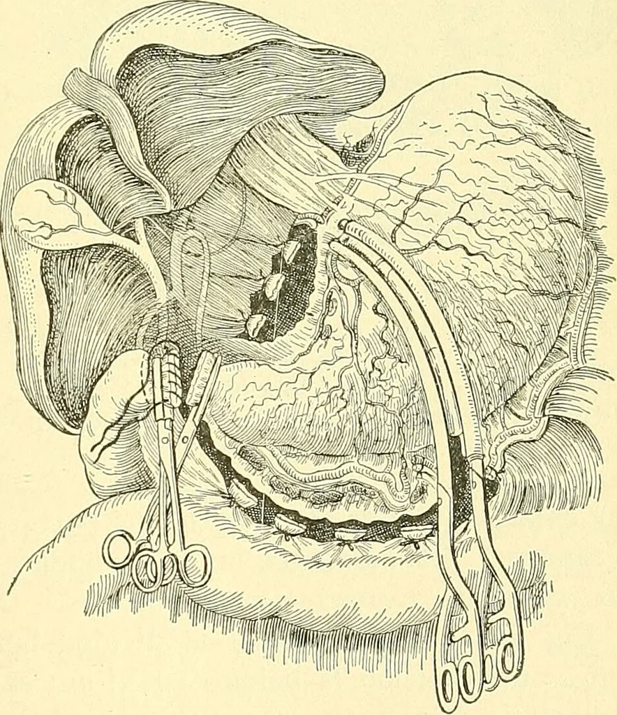 An illustration from Modern surgery, general and operative / by John Chalmers Da Costa., 1907, leaf 949