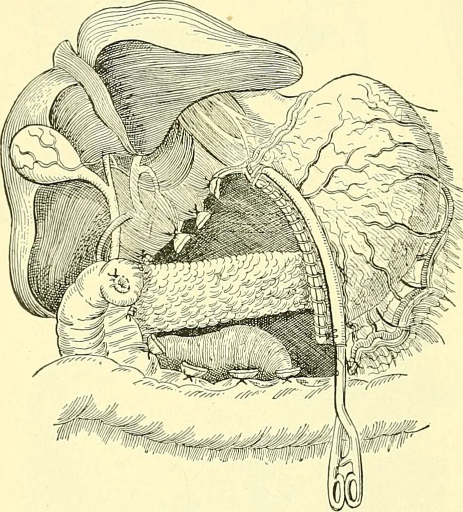 An illustration from Modern surgery, general and operative / by John Chalmers Da Costa., 1907, leaf 950