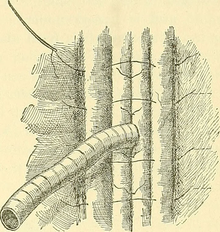 An illustration from Modern surgery, general and operative / by John Chalmers Da Costa., 1907, leaf 953