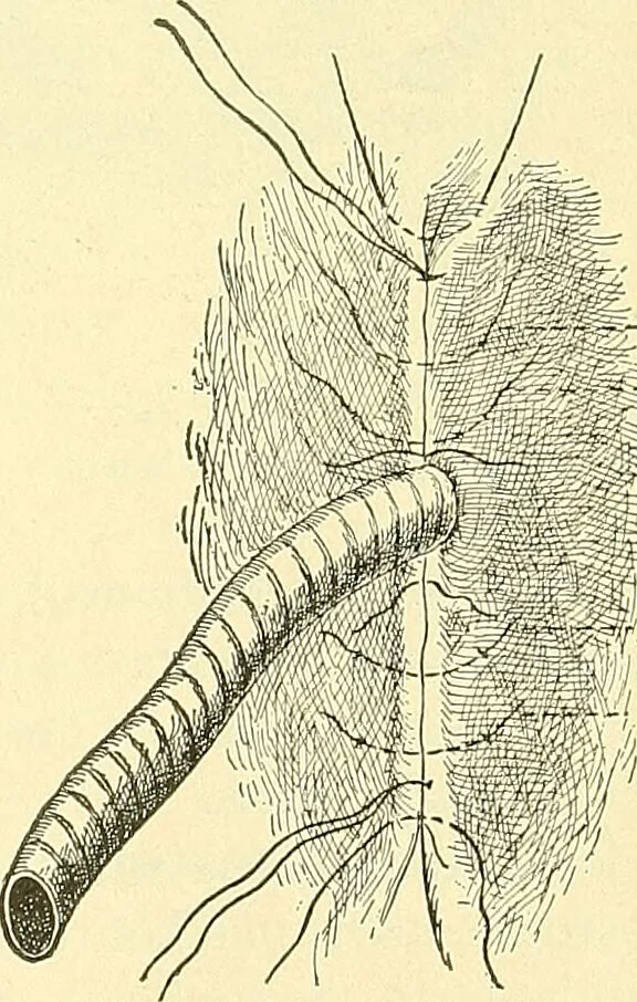 An illustration from Modern surgery, general and operative / by John Chalmers Da Costa., 1907, leaf 953