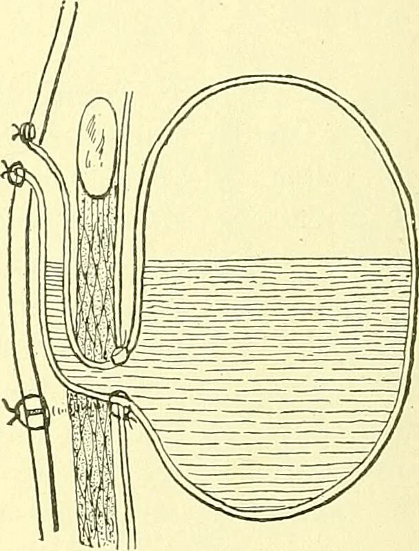 An illustration from Modern surgery, general and operative / by John Chalmers Da Costa., 1907, leaf 954