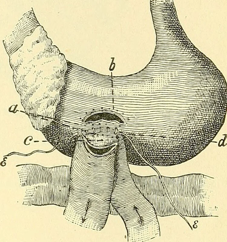 An illustration from Modern surgery, general and operative / by John Chalmers Da Costa., 1907, leaf 959
