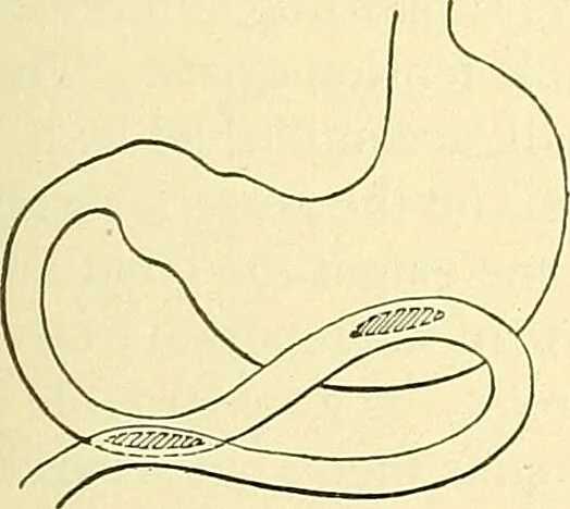 An illustration from Modern surgery, general and operative / by John Chalmers Da Costa., 1907, leaf 961