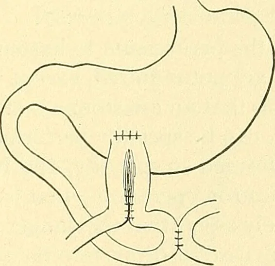 An illustration from Modern surgery, general and operative / by John Chalmers Da Costa., 1907, leaf 961