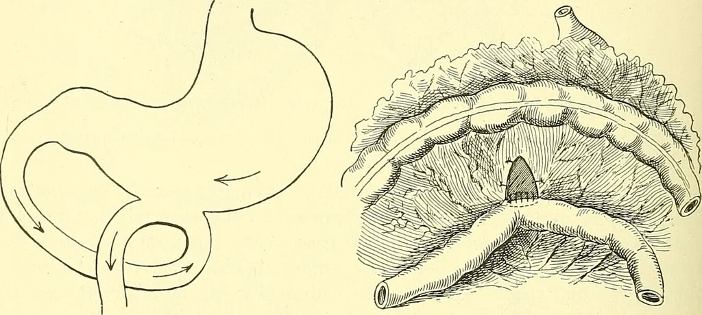 An illustration from Modern surgery, general and operative / by John Chalmers Da Costa., 1907, leaf 962