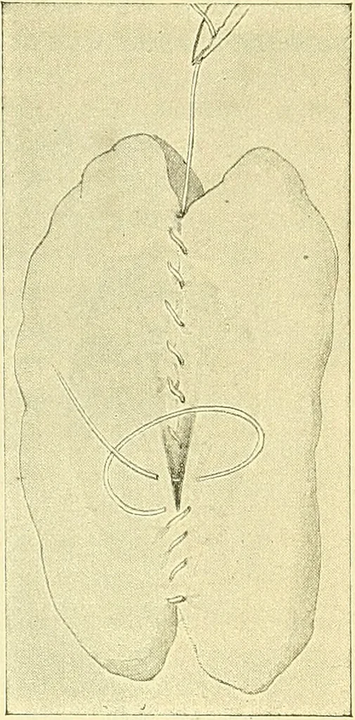 An illustration from Modern surgery, general and operative / by John Chalmers Da Costa., 1907, leaf 967