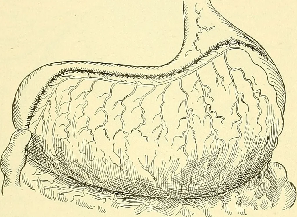 An illustration from Modern surgery, general and operative / by John Chalmers Da Costa., 1907, leaf 969