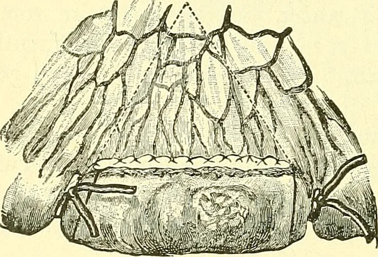 An illustration from Modern surgery, general and operative / by John Chalmers Da Costa., 1907, leaf 972