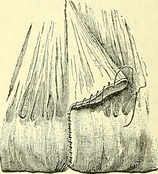 An illustration from Modern surgery, general and operative / by John Chalmers Da Costa., 1907, leaf 972