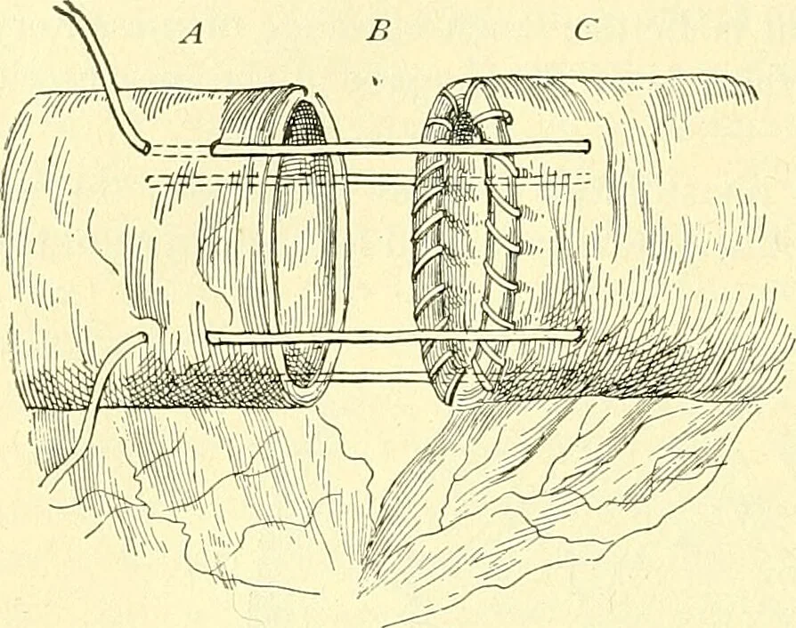 An illustration from Modern surgery, general and operative / by John Chalmers Da Costa., 1907, leaf 974